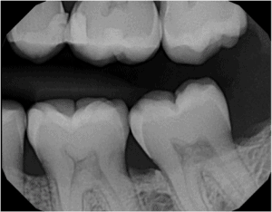bite-wing-dental-x-ray-by-your-idaho-falls-dentist
