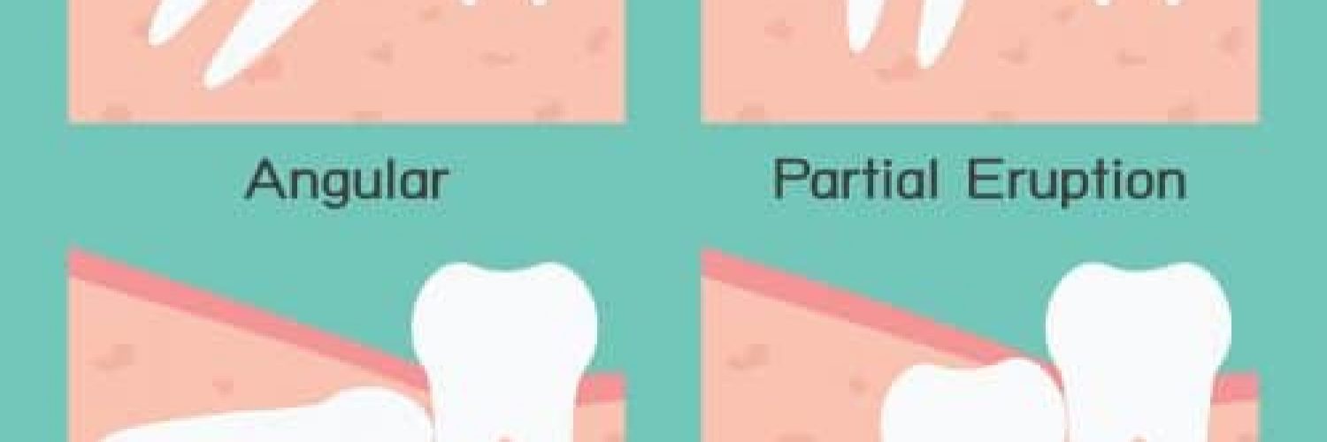 four types of an impacted wisdom tooth