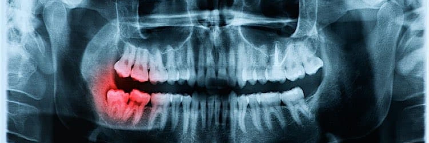 Panoramic x-ray image of teeth and mouth with wisdom teeth