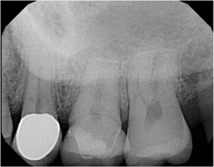 periapical-dental-x-ray-by-your-idaho-falls-dentist